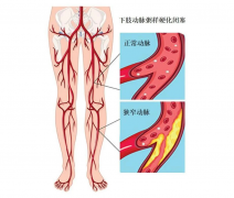 好好一个人变残疾了！腿上出现这些变化，请立即就医！